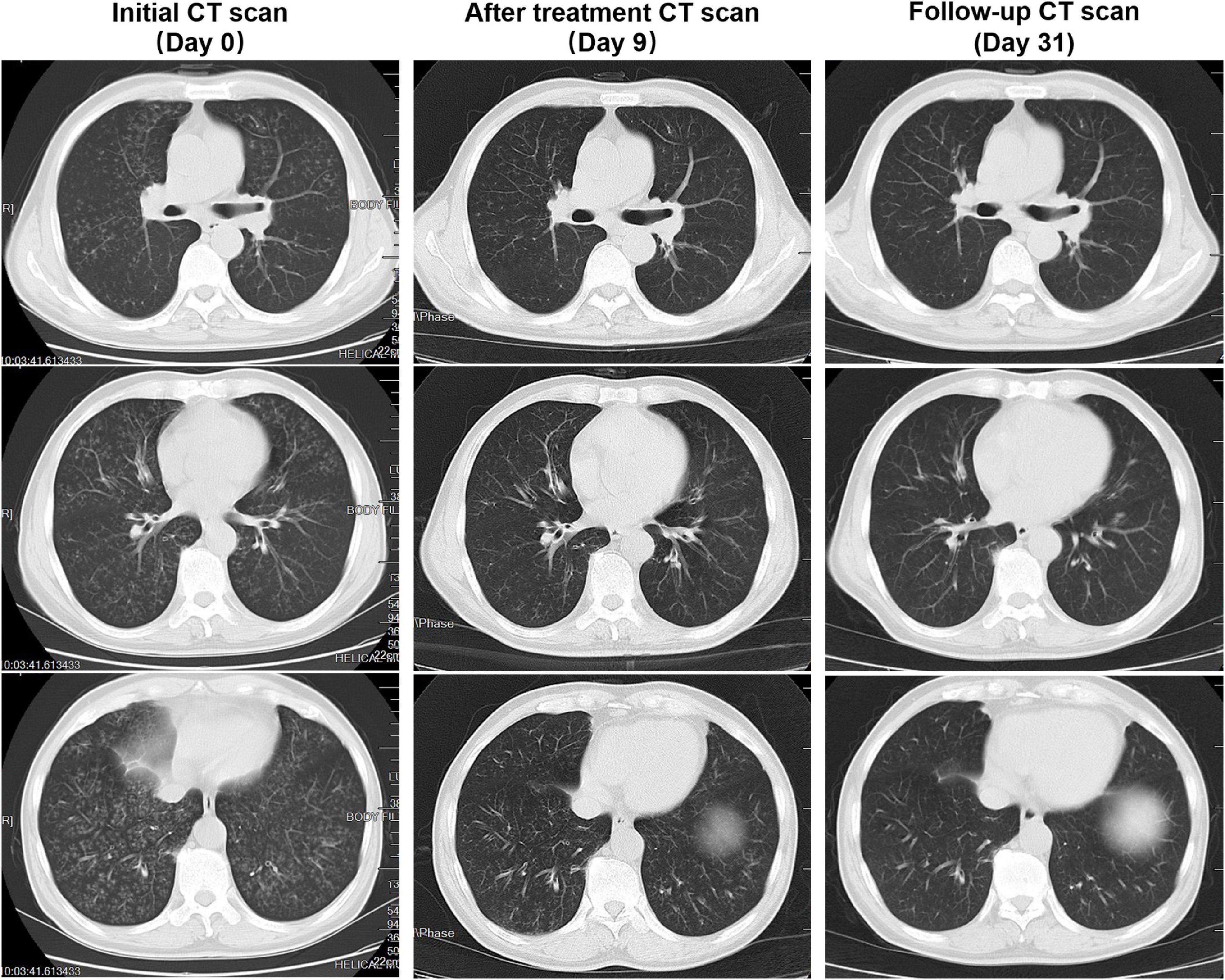 Case report: Streptococcus pneumoniae pneumonia characterized by diffuse centrilobular nodules in both lungs